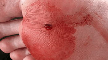 عکس زخم های حفره ای و تونلی