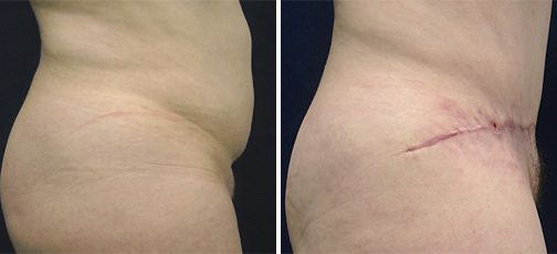 عکس زخم زخم ناشی از ابدومینوپلاستی یا تامی تاک