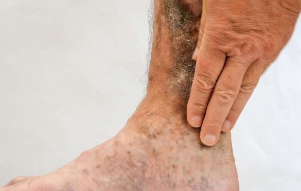 عکس زخم واریسی
