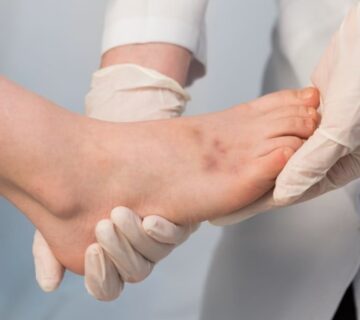 پیشگیری از قانقاریا