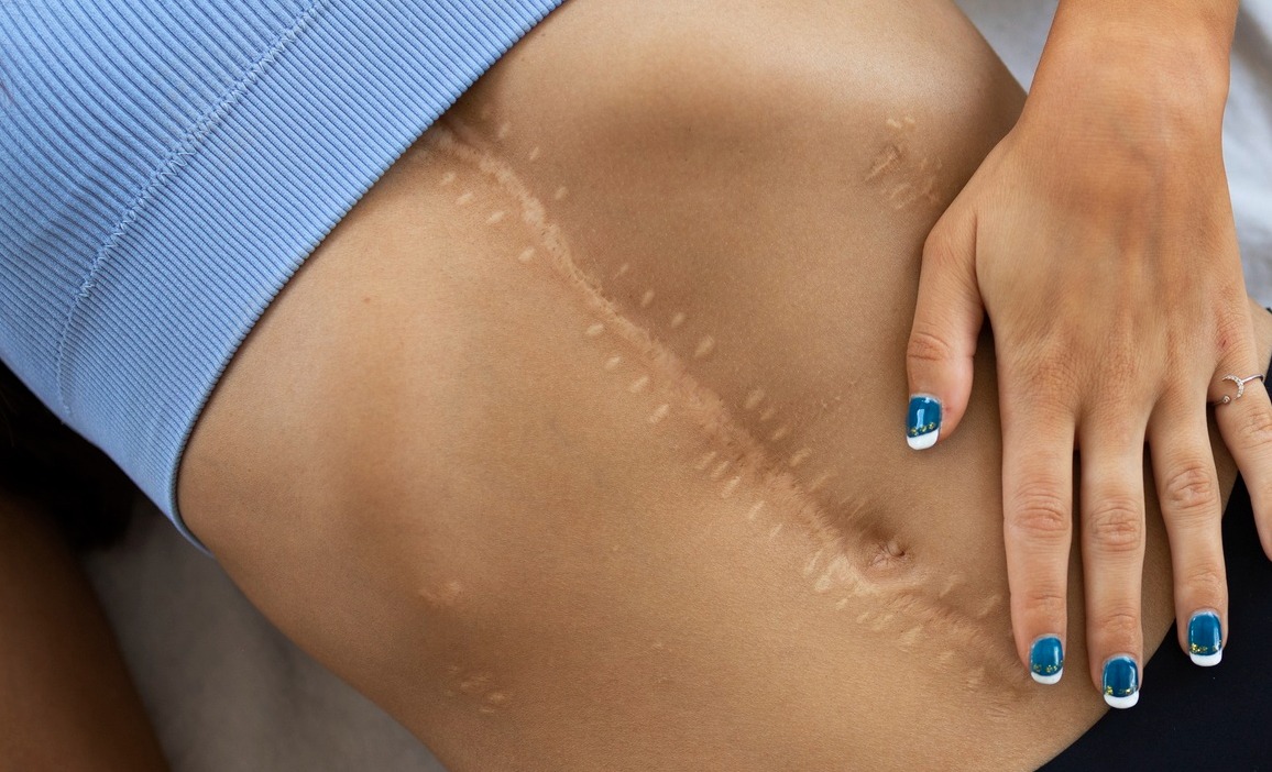 ترمیم کننده زخم