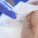 دیر خوب شدن زخم جراحی