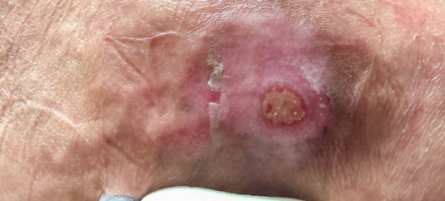 عکس زخم بستر