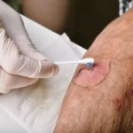 زخم های حفره ای و تونلی