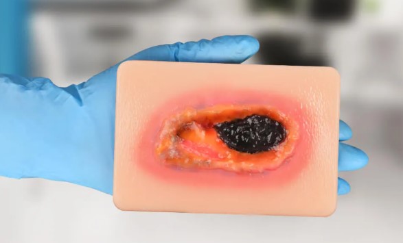 عکس زخم نکروز یا نکروتیک