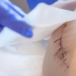 پانسمان زخم باز جراحی