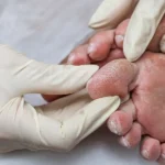 انواع عفونت ها در افراد دیابتی