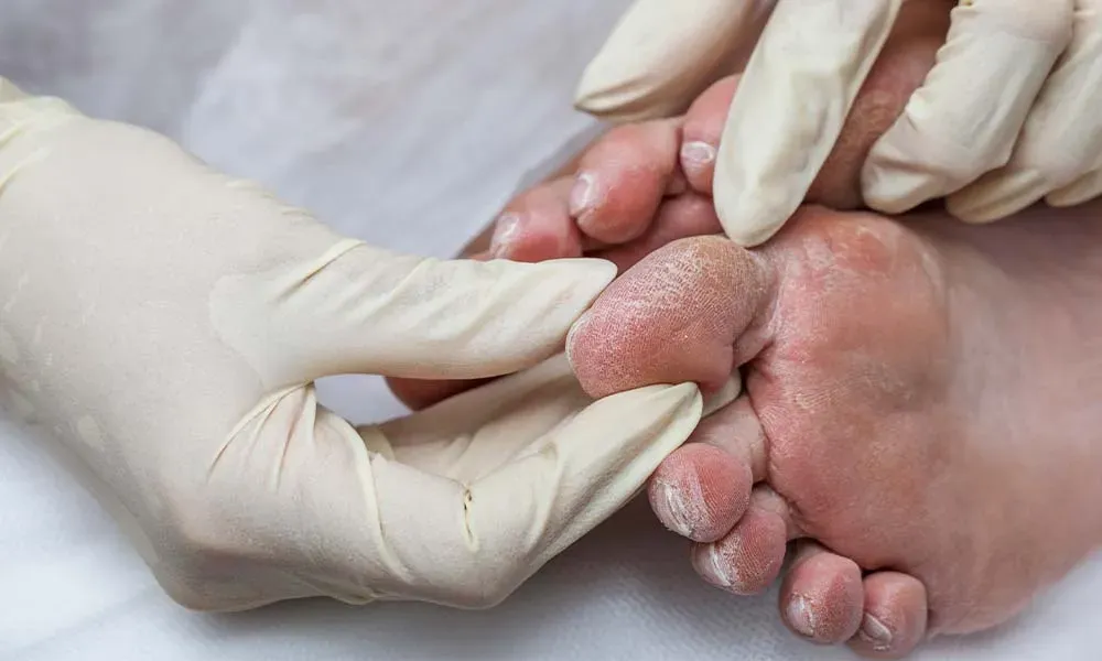 انواع عفونت ها در افراد دیابتی