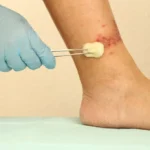 زخم شریانی یا ایسکمیک