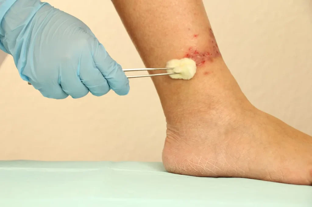 زخم شریانی یا ایسکمیک