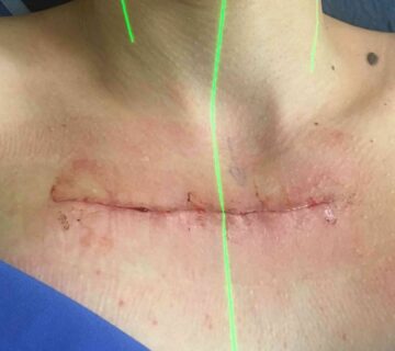 پانسمان زخم های جراحی دیر جوش