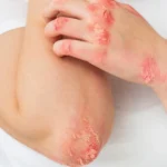 سوختگی های شیمیایی و پانسمان