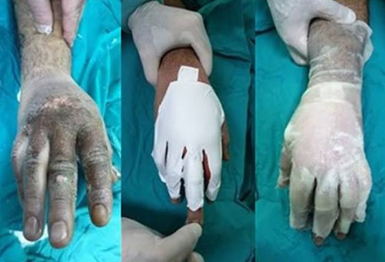 عکس سوختگی شیمیایی